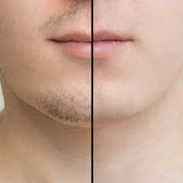 Sideburns, Mustache, and Beard Transplant Treatment