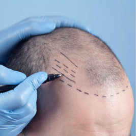Exercise After a Hair Transplant